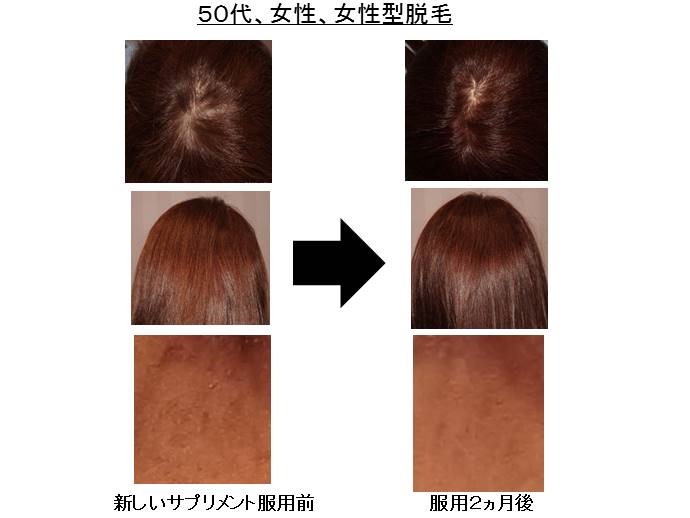 女性　脱毛症　病院""